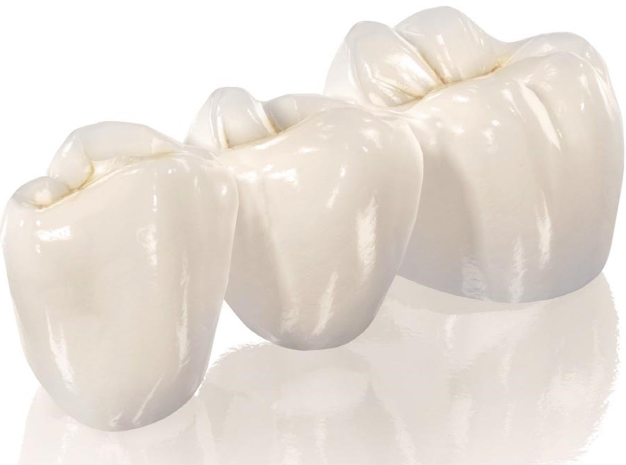 Протезирование зубов - Безметалловые коронки диоксид циркония